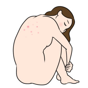 ニキビは尋常性ざ瘡というれっきとした皮膚疾患